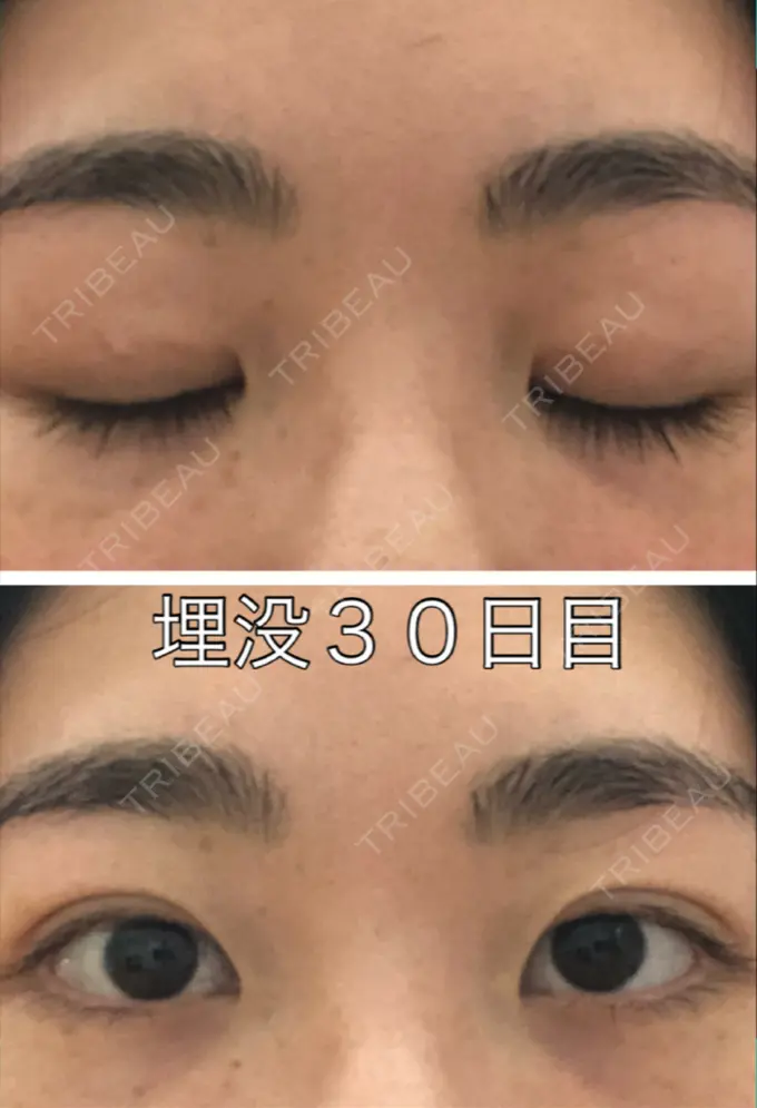 二重埋没 新宿美容外科クリニック 立川院 DAY 29 メイン用