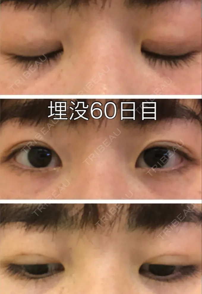 二重埋没 新宿美容外科クリニック 立川院 AFTER メイン用