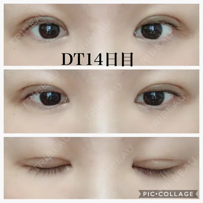 二重切開 水の森美容クリニック 名古屋院 DAY 14 メイン用