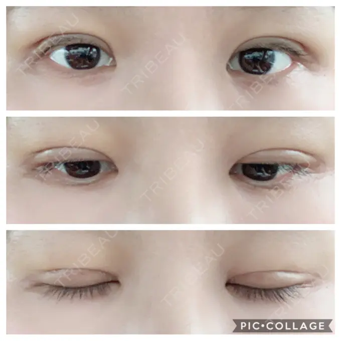 二重切開 水の森美容クリニック 名古屋院 DAY 14 メイン用