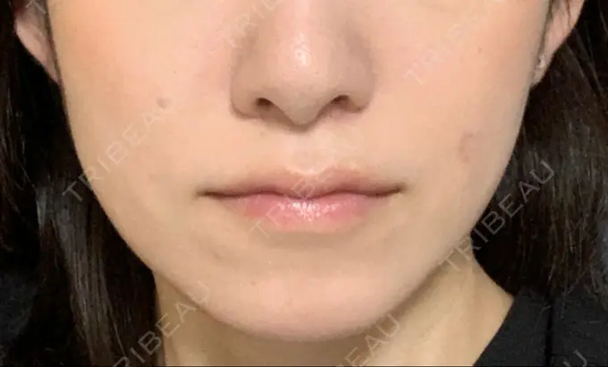 ボトックス（エラ・小顔） TCB東京中央美容外科 郡山院 DAY 146 メイン用