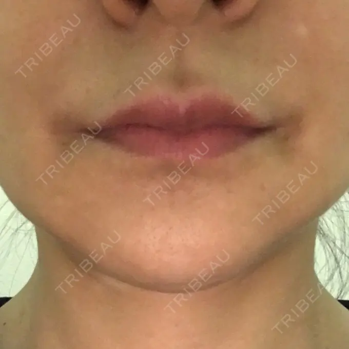 ルフォー+ssro（両あご) id（アイディ）美容外科 DAY 99 メイン用