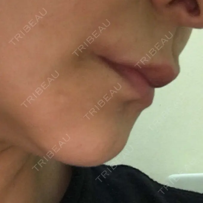 ルフォー+ssro（両あご) id（アイディ）美容外科 DAY 99 メイン用