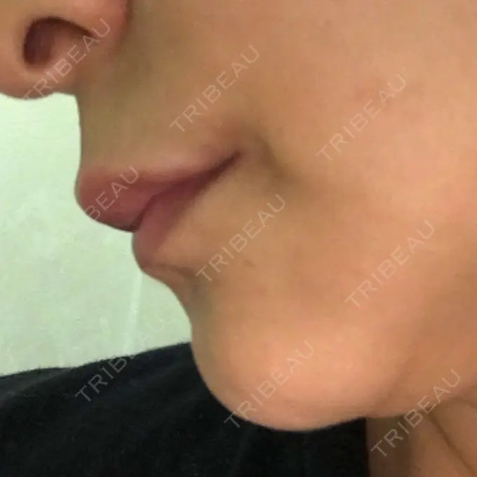 ルフォー+ssro（両あご) id（アイディ）美容外科 DAY 99 メイン用