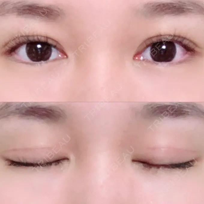 二重切開 / 上まぶたの脂肪取り / その他（目元） 湘南美容クリニック 新宿本院 DAY 65 メイン用