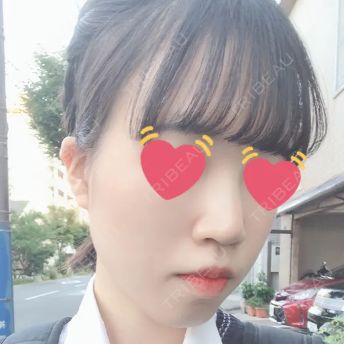 ヒアルロン酸注入（鼻） 東京ヒルズクリニック 岡崎院 DAY 4 メイン用