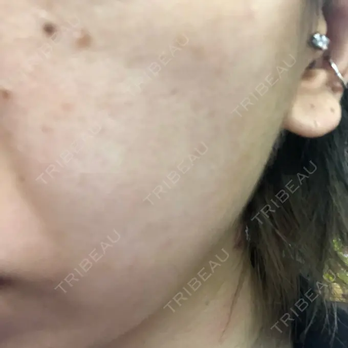 水光注射（ハリ・美肌） Wクリニック 心斎橋院 AFTER メイン用