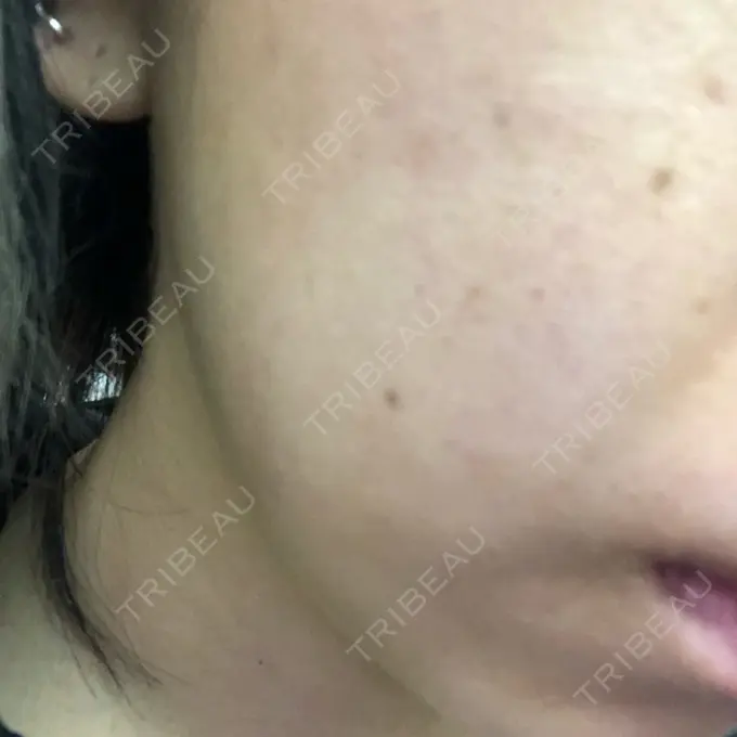 水光注射（ハリ・美肌） Wクリニック 心斎橋院 DAY 2 メイン用