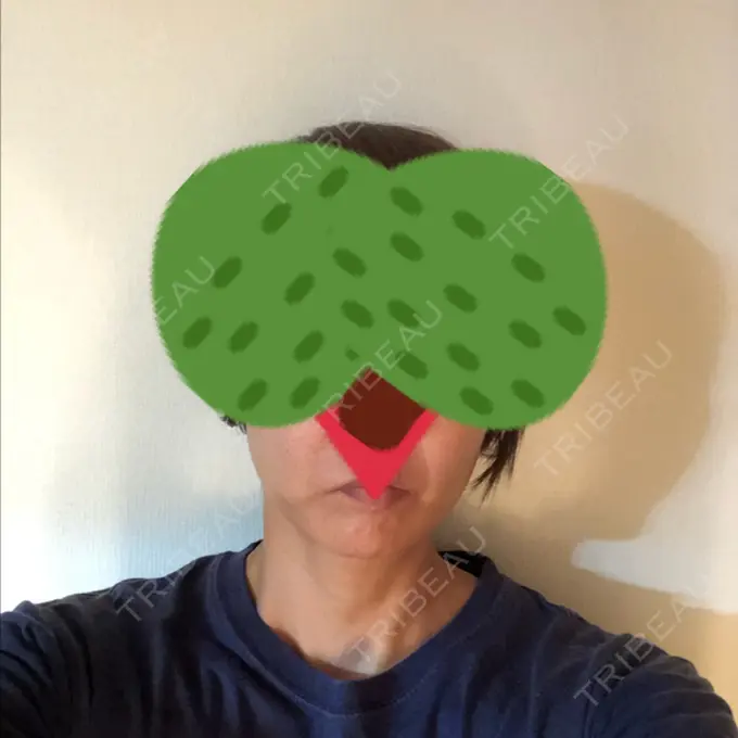 糸リフト / バッカルファット除去 / 肌ヒアルロン酸注入（たるみ・シワ改善） 大阪TAクリニック AFTER メイン用