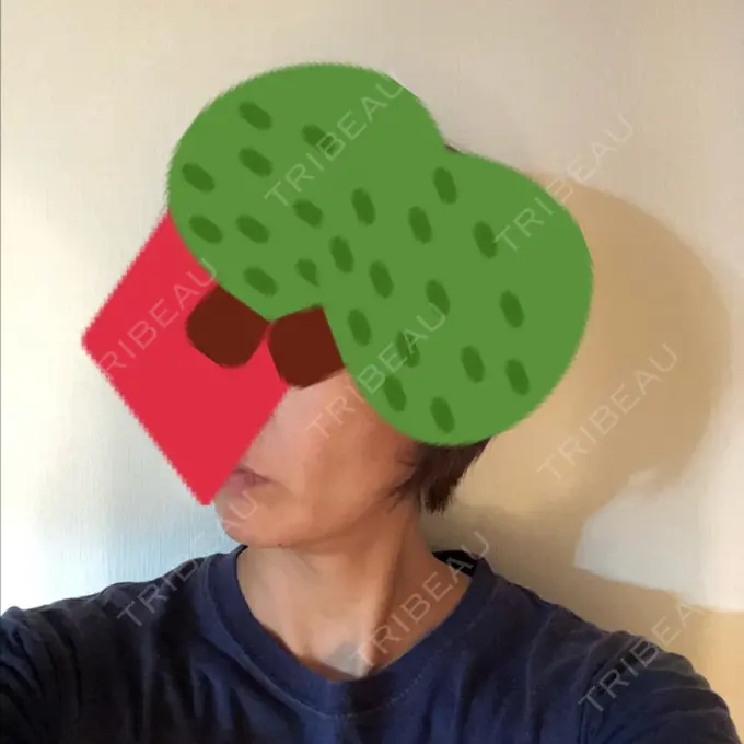 糸リフト / バッカルファット除去 / 肌ヒアルロン酸注入（たるみ・シワ改善） 大阪TAクリニック DAY 40 メイン用