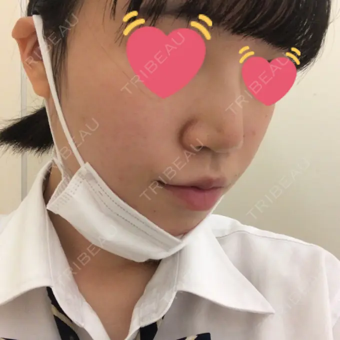 ヒアルロン酸注入（鼻） 東京ヒルズクリニック 岡崎院 DAY 5 メイン用