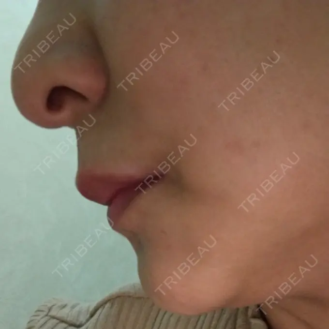 ルフォー+ssro（両あご) id（アイディ）美容外科 DAY 100 メイン用