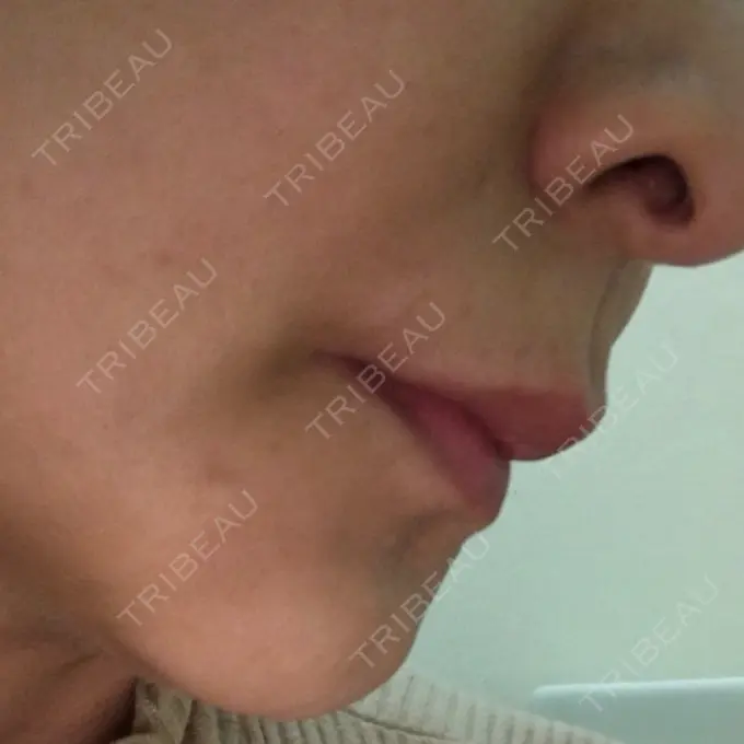 ルフォー+ssro（両あご) id（アイディ）美容外科 DAY 100 メイン用