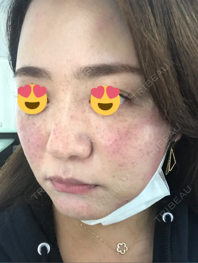 プラセンタ注射 / フォトRF / フォトシルクプラス 品川スキンクリニック品川院 DAY 0 メイン用