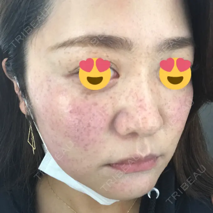 プラセンタ注射 / フォトRF / フォトシルクプラス 品川スキンクリニック品川院 DAY 0 メイン用