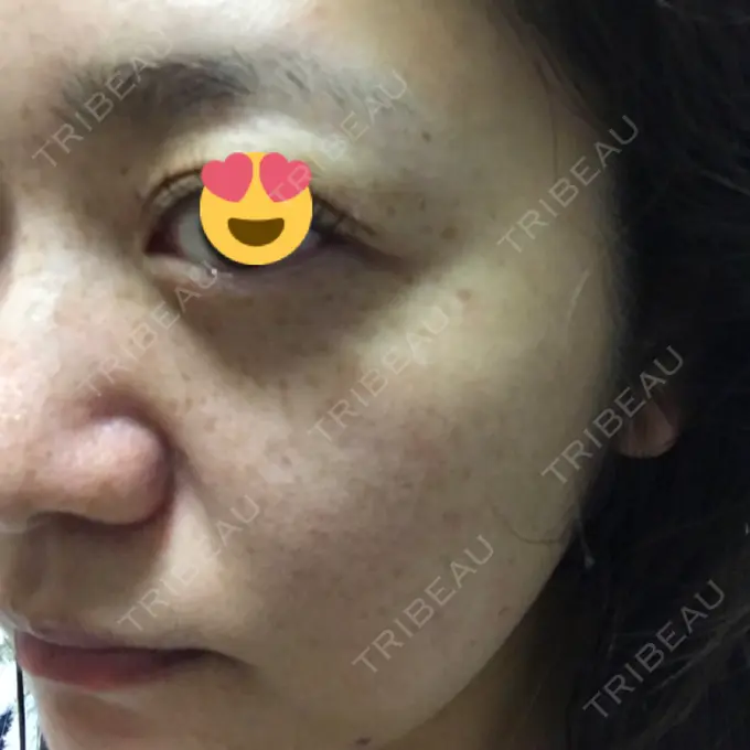 プラセンタ注射 / フォトRF / フォトシルクプラス 品川スキンクリニック品川院 AFTER メイン用