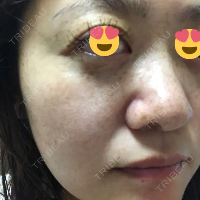 プラセンタ注射 / フォトRF / フォトシルクプラス 品川スキンクリニック品川院 DAY 5 メイン用