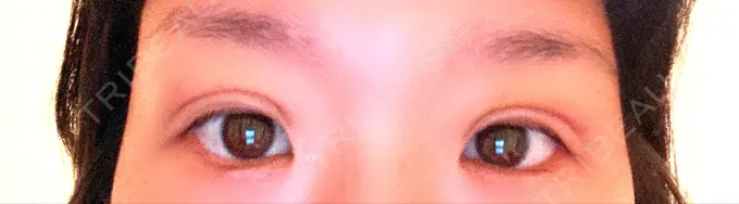 二重埋没 湘南美容クリニック 京都院 DAY 7 メイン用