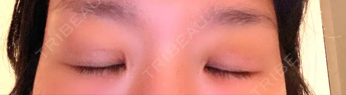 二重埋没 湘南美容クリニック 京都院 DAY 7 メイン用