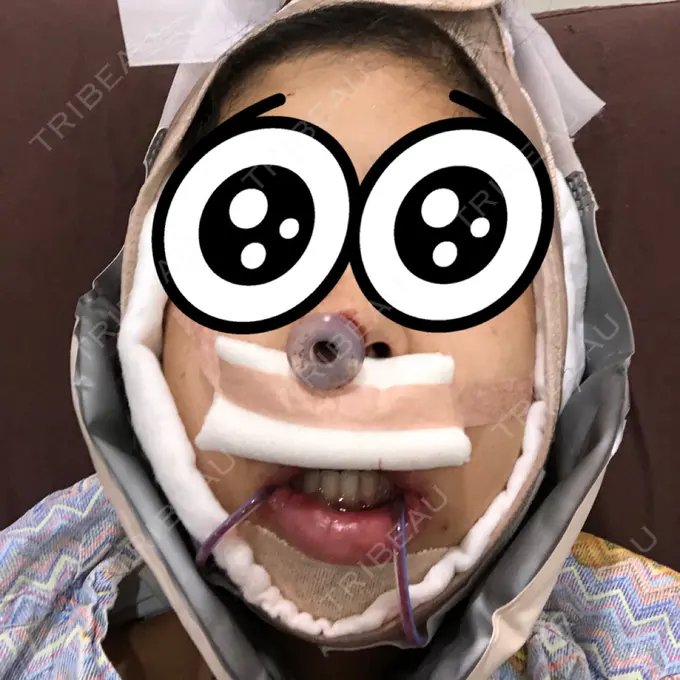 ルフォー+ssro（両あご) / その他（輪郭） View美容整形外科 DAY 1 メイン用