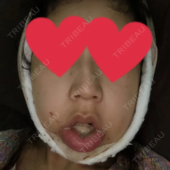 ルフォー+ssro（両あご) / その他（輪郭） View美容整形外科 DAY 2 メイン用