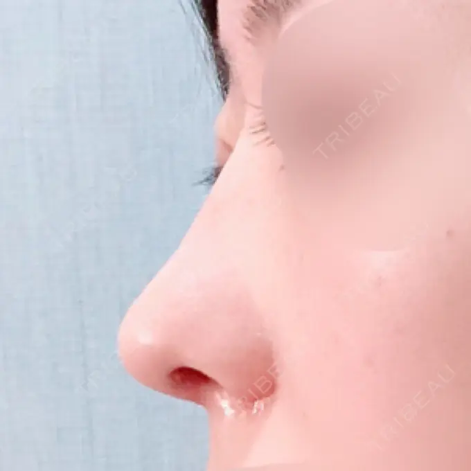 鼻中隔延長（切開） / 小鼻縮小（切開） / 軟骨移植 / 骨切幅寄せ / 鼻尖縮小 / 鼻孔縁下降 加美（GAMI）整形外科 DAY 21 メイン用