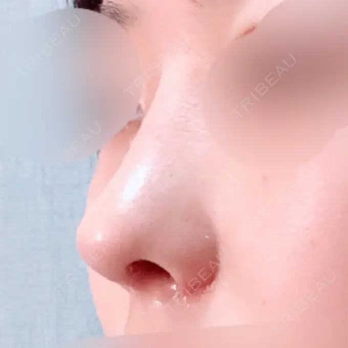 鼻中隔延長（切開） / 小鼻縮小（切開） / 軟骨移植 / 骨切幅寄せ / 鼻尖縮小 / 鼻孔縁下降 加美（GAMI）整形外科 DAY 21 メイン用