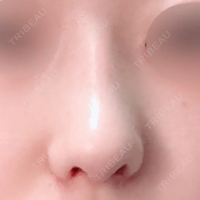 鼻中隔延長（切開） / 小鼻縮小（切開） / 軟骨移植 / 骨切幅寄せ / 鼻尖縮小 / 鼻孔縁下降 加美（GAMI）整形外科 DAY 21 メイン用