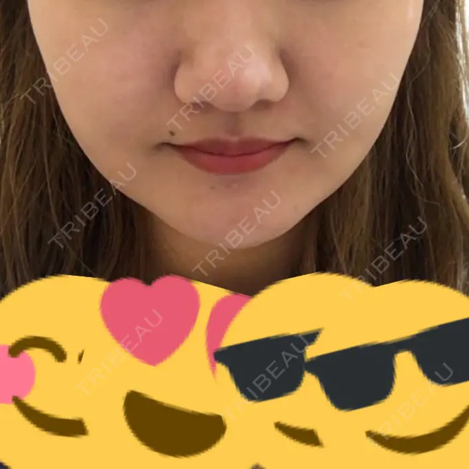 脂肪吸引（顔） アサミ美容外科 渋谷院 DAY 20 メイン用