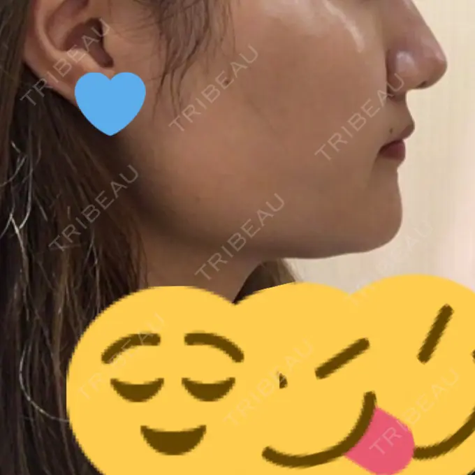 脂肪吸引（顔） アサミ美容外科 渋谷院 DAY 20 メイン用