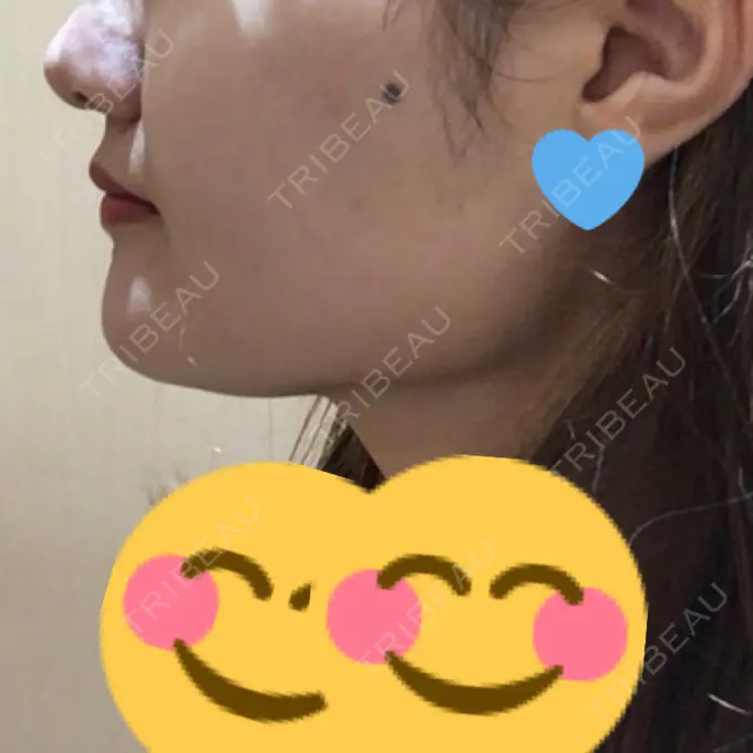 脂肪吸引（顔） アサミ美容外科 渋谷院 DAY 20 メイン用