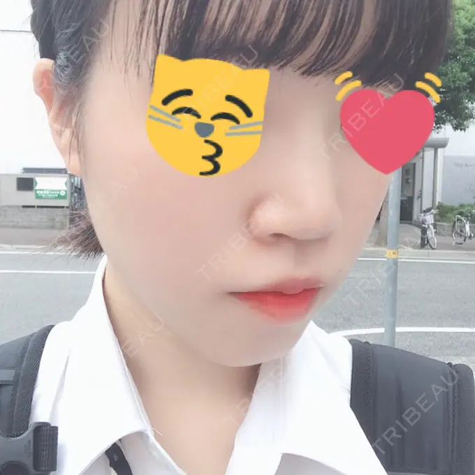 ヒアルロン酸注入（鼻） 東京ヒルズクリニック 岡崎院 DAY 6 メイン用