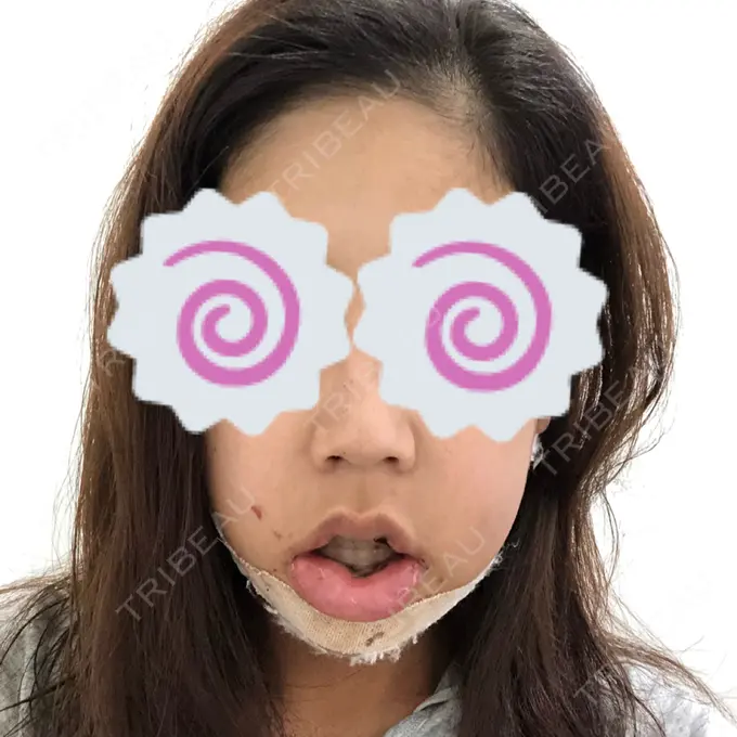 ルフォー+ssro（両あご) / その他（輪郭） View美容整形外科 DAY 3 メイン用