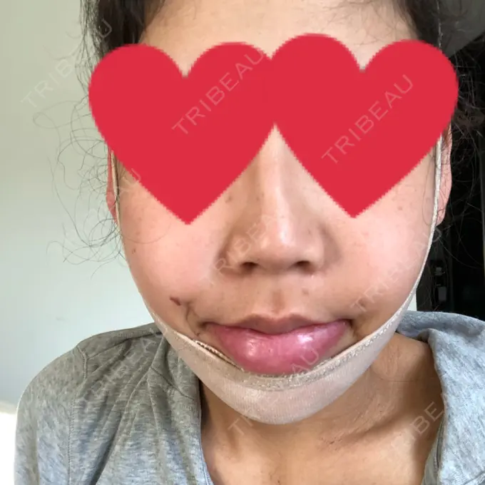 ルフォー+ssro（両あご) / その他（輪郭） View美容整形外科 DAY 4 メイン用