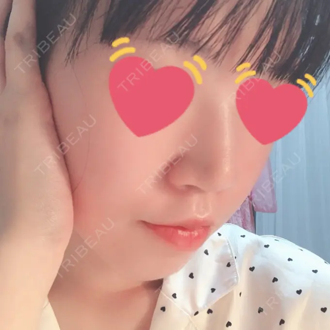 ヒアルロン酸注入（鼻） 東京ヒルズクリニック 岡崎院 DAY 7 メイン用