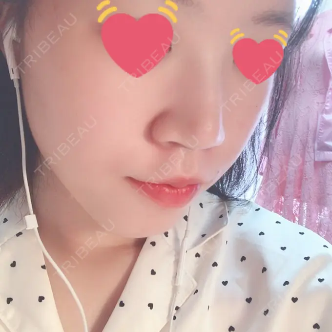 ヒアルロン酸注入（鼻） 東京ヒルズクリニック 岡崎院 DAY 8 メイン用