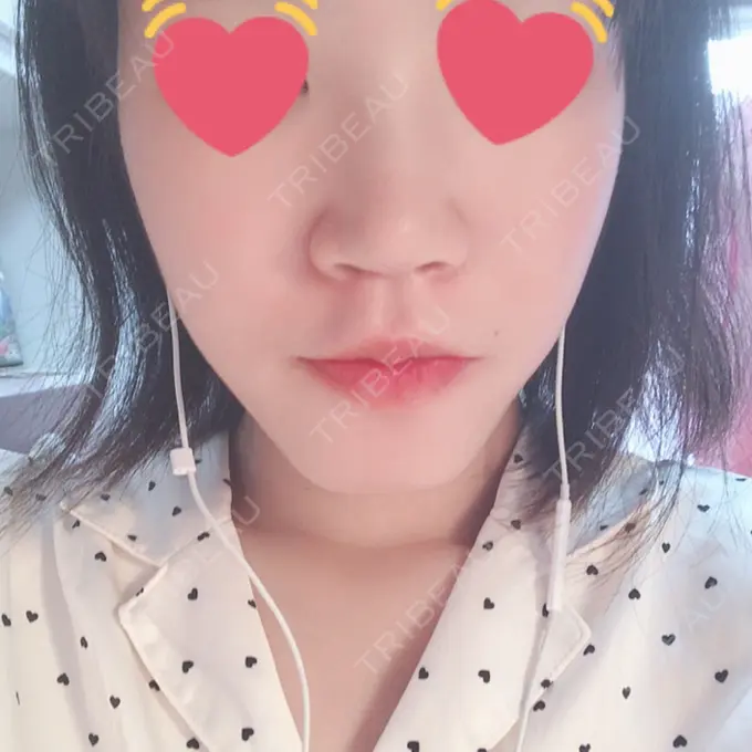 鼻尖縮小 / ヒアルロン酸注入（鼻） 東京ヒルズクリニック 岡崎院 DAY 8 メイン用