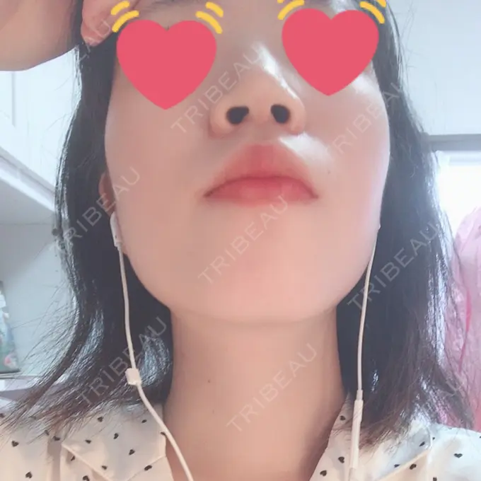 鼻尖縮小 / ヒアルロン酸注入（鼻） 東京ヒルズクリニック 岡崎院 DAY 8 メイン用