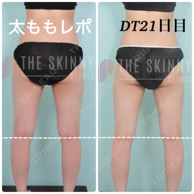 ボトックス（ふくらはぎ） / 脂肪溶解注射 / 脂肪溶解注射（太もも） / その他（ボディ） THE SKINNY CLINIC（ザ・スキニークリニック） DAY 21 メイン用