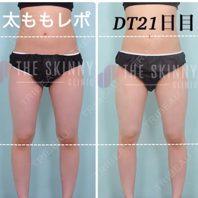 ボトックス（ふくらはぎ） / 脂肪溶解注射 / 脂肪溶解注射（太もも） / その他（ボディ） THE SKINNY CLINIC（ザ・スキニークリニック） DAY 21 メイン用