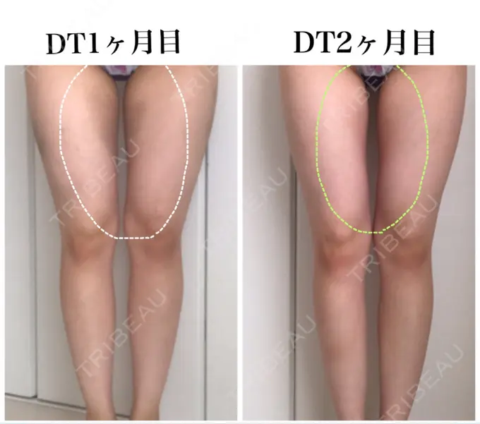 ボトックス（ふくらはぎ） / 脂肪溶解注射 / 脂肪溶解注射（太もも） / その他（ボディ） THE SKINNY CLINIC（ザ・スキニークリニック） DAY 60 メイン用