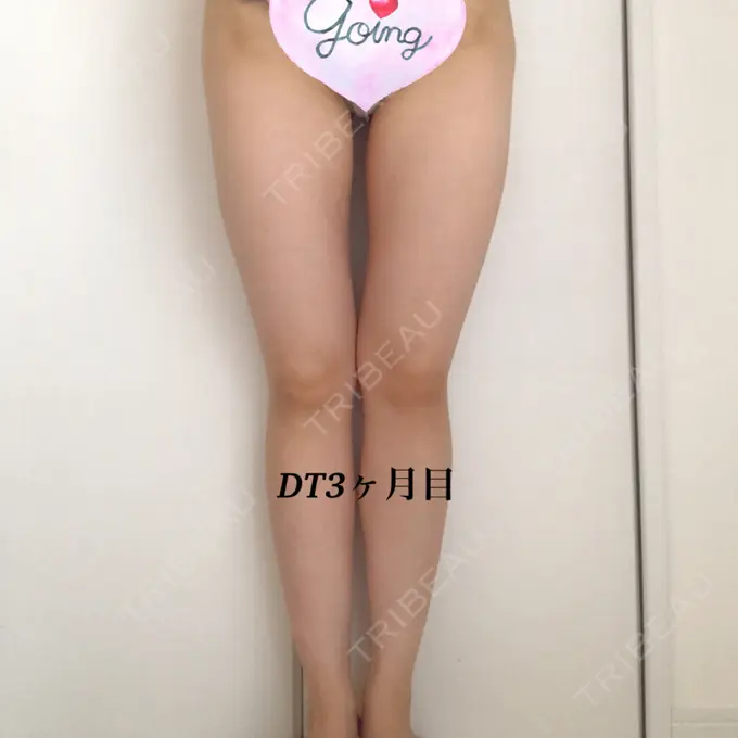 ボトックス（ふくらはぎ） / 脂肪溶解注射 / 脂肪溶解注射（太もも） / その他（ボディ） THE SKINNY CLINIC（ザ・スキニークリニック） DAY 90 メイン用