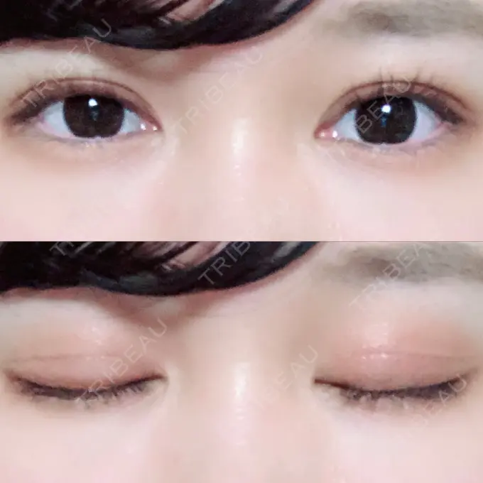 二重切開 / 上まぶたの脂肪取り / その他（目元） 湘南美容クリニック 新宿本院 DAY 70 メイン用