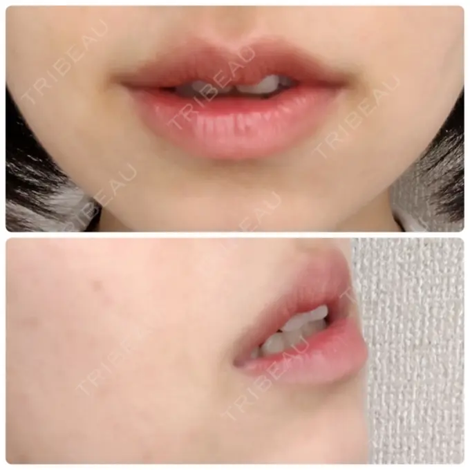 口唇縮小術 品川スキンクリニック表参道院 AFTER メイン用