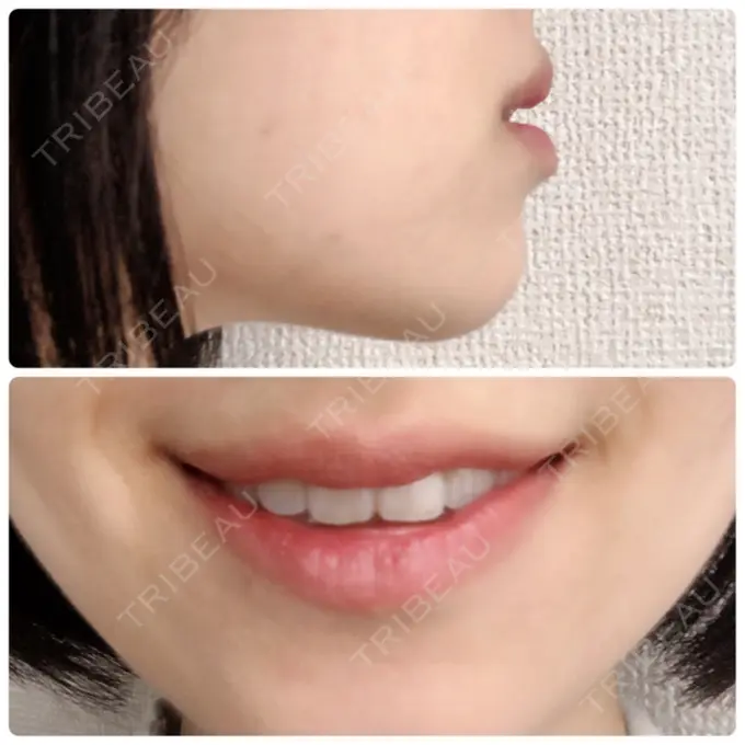 口唇縮小術 品川スキンクリニック表参道院 DAY 170 メイン用