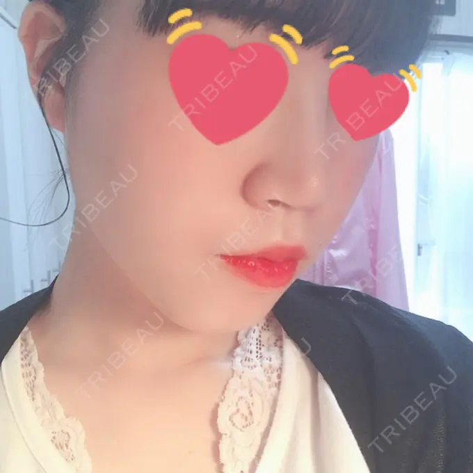 ヒアルロン酸注入（鼻） 東京ヒルズクリニック 岡崎院 DAY 9 メイン用