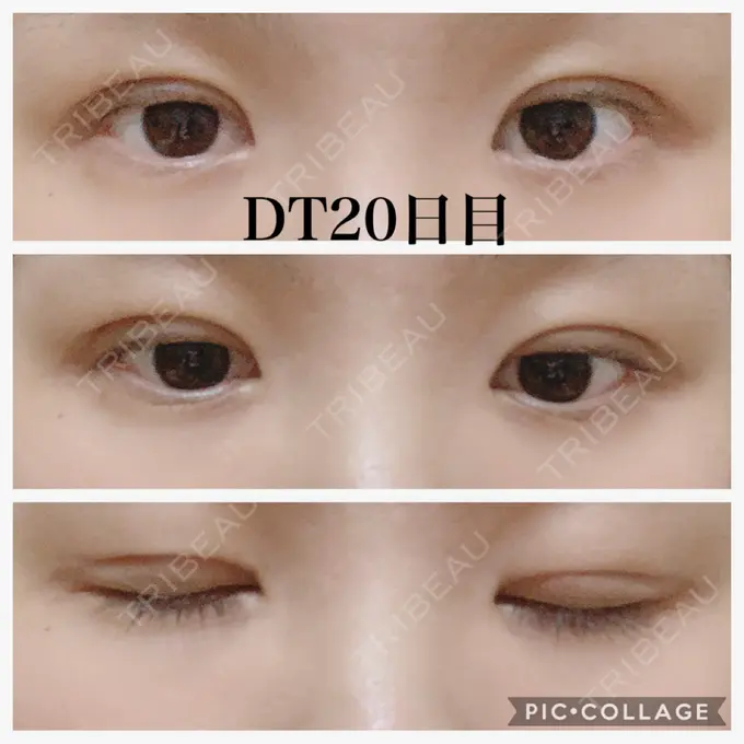 二重切開 水の森美容クリニック 名古屋院 DAY 20 メイン用