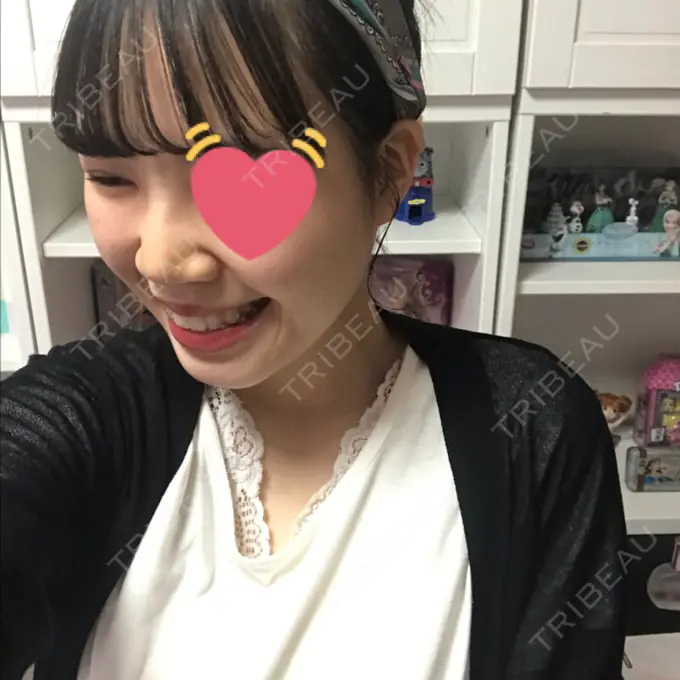 鼻尖縮小 / ヒアルロン酸注入（鼻） 東京ヒルズクリニック 岡崎院 DAY 9 メイン用