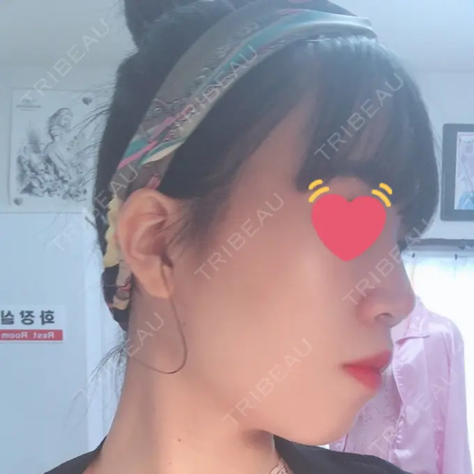 鼻尖縮小 / ヒアルロン酸注入（鼻） 東京ヒルズクリニック 岡崎院 DAY 9 メイン用