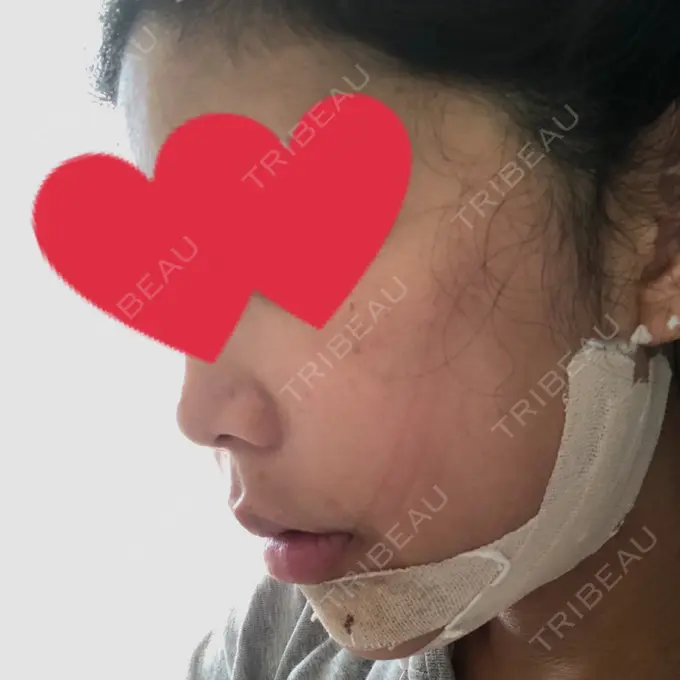 ルフォー+ssro（両あご) / その他（輪郭） View美容整形外科 DAY 7 メイン用